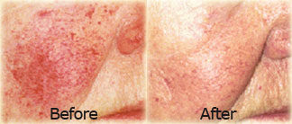 Linda Martin - Before & After